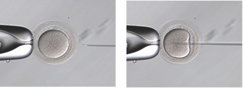 顕微授精－胚移植（ＩＣＳＩ）