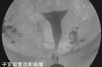 子宮卵管造影画像